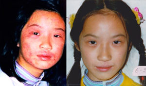 Khoa học chứng thực bệnh nan y đôi khi có thể khỏi mà không cần điều trị y tế