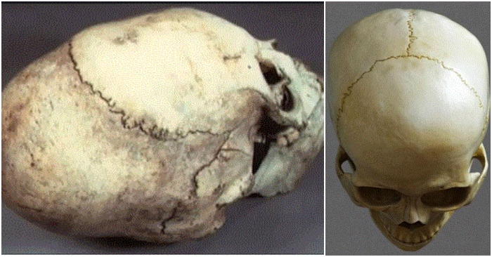 Mảnh ghép xương của hộp sọ dài và mảnh ghép xương của sọ người bình thường (ảnh ghép Internet).