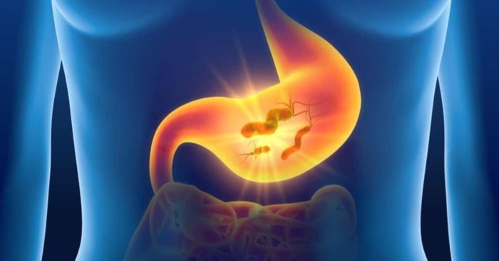 5 dấu hiệu sớm của ung thư dạ dày bạn cần cảnh giác