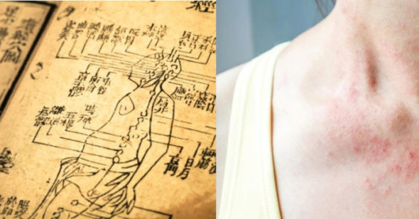 Trung y cổ đại điều trị bệnh Zona thần kinh